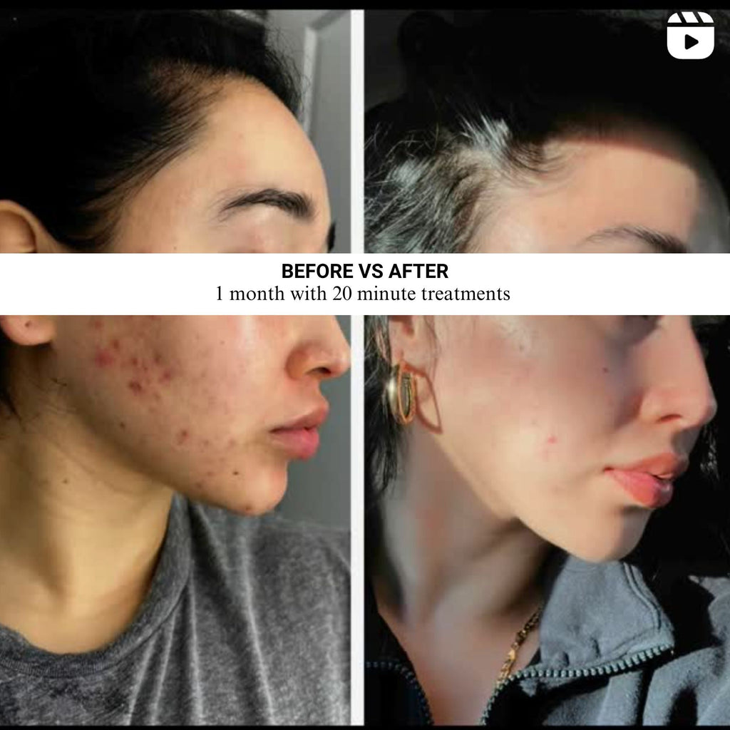 VISO - Anti-Aging Red Light Mask